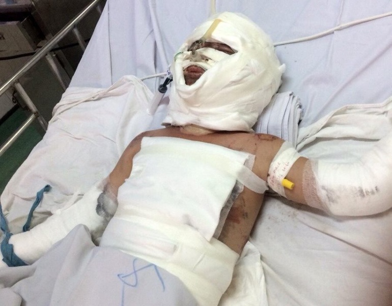 Giúp cháu Huy bị bỏng nặng